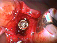 インプラント治療