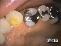 治療例 221 - 審美歯科