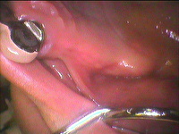 治療例 222 - インプラント