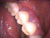 インプラント例